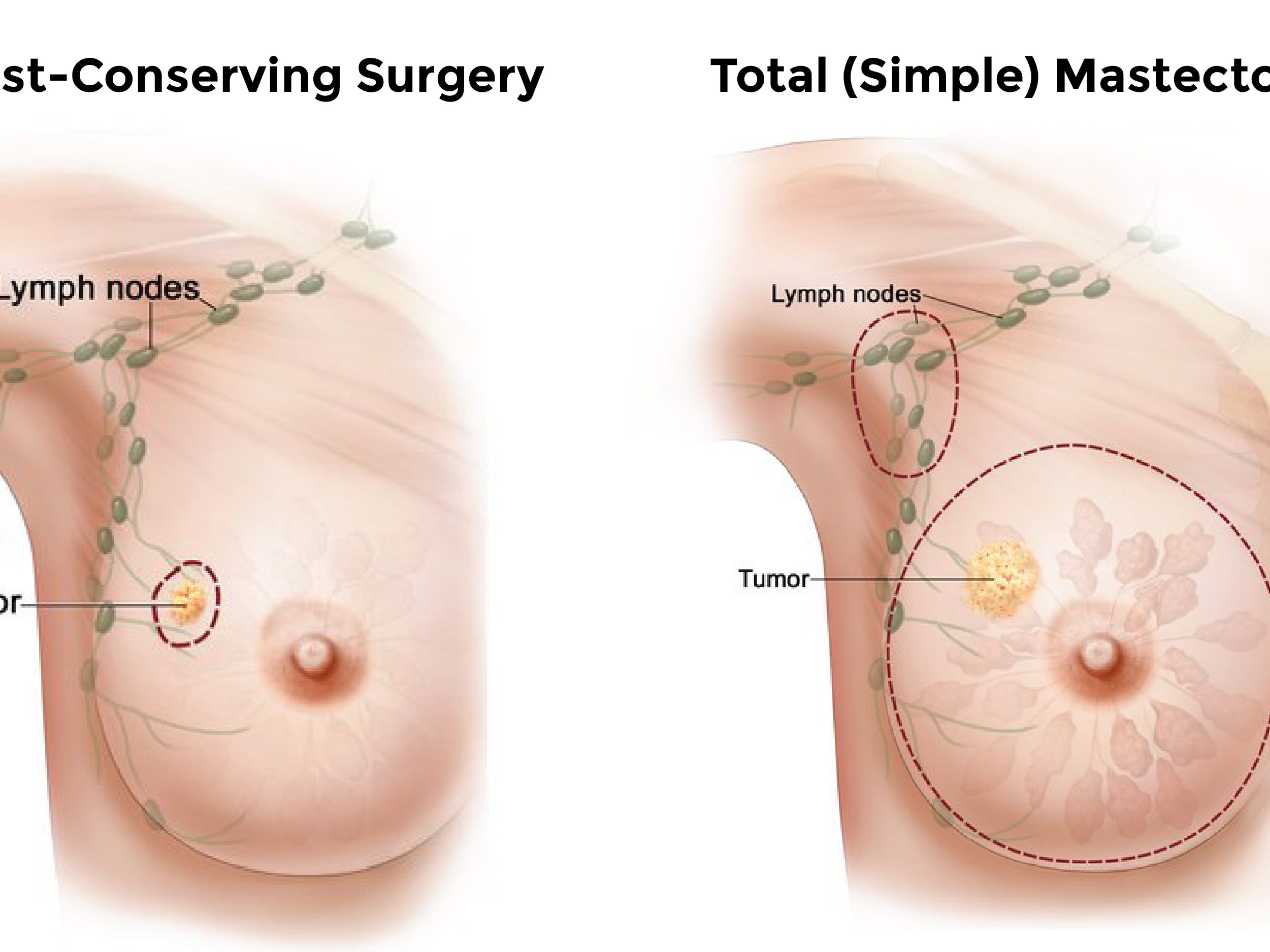 Breast Cancer Analysis